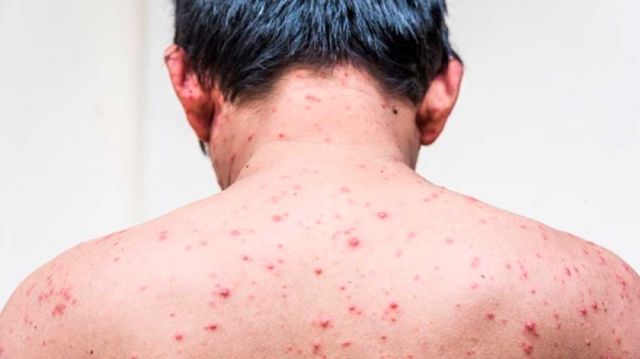 Alerta sanitaria en Potosí por aumento de casos de varicela
